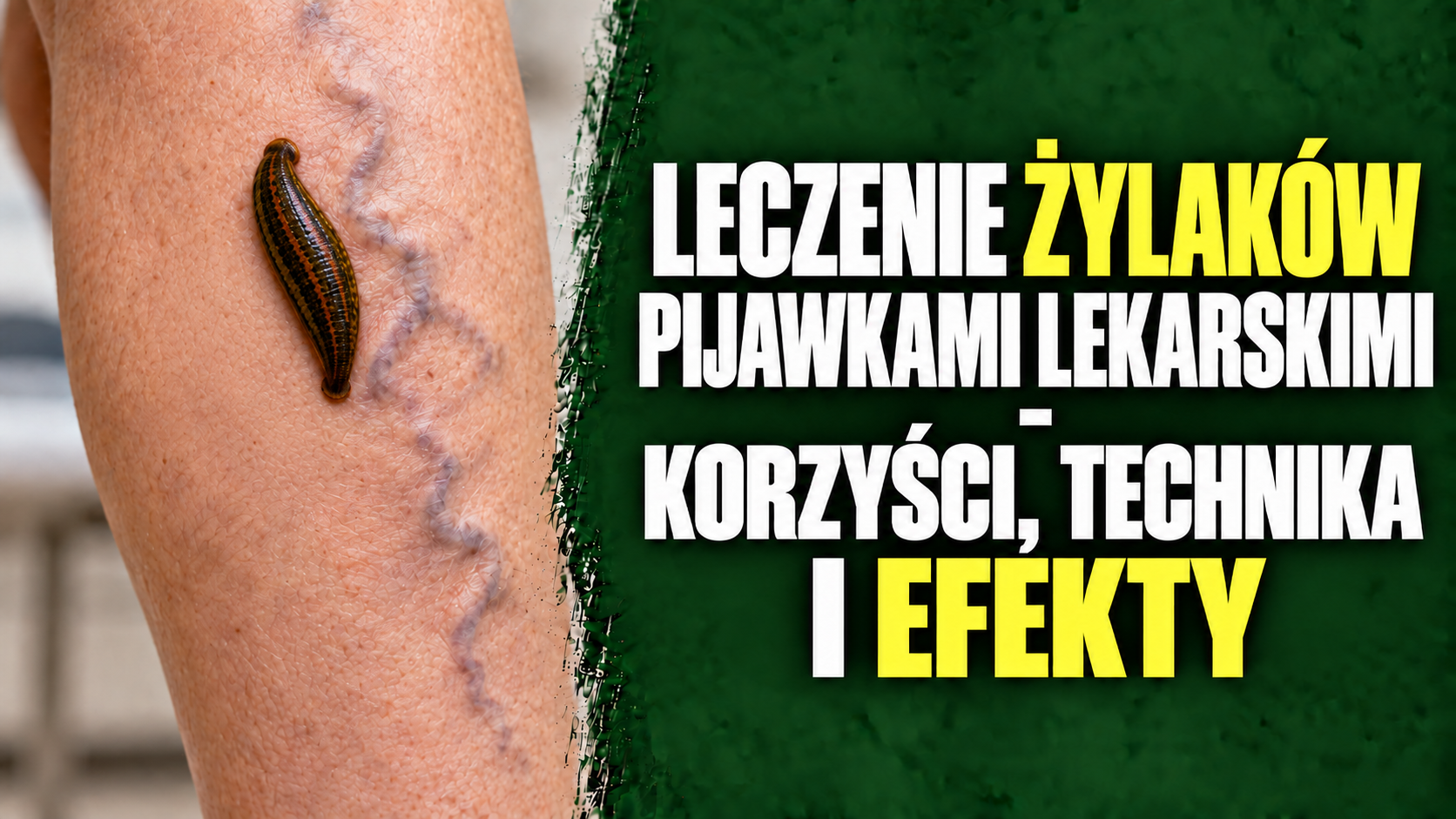 Leczenie żylaków pijawkami lekarskimi - korzyści, technika i efekty